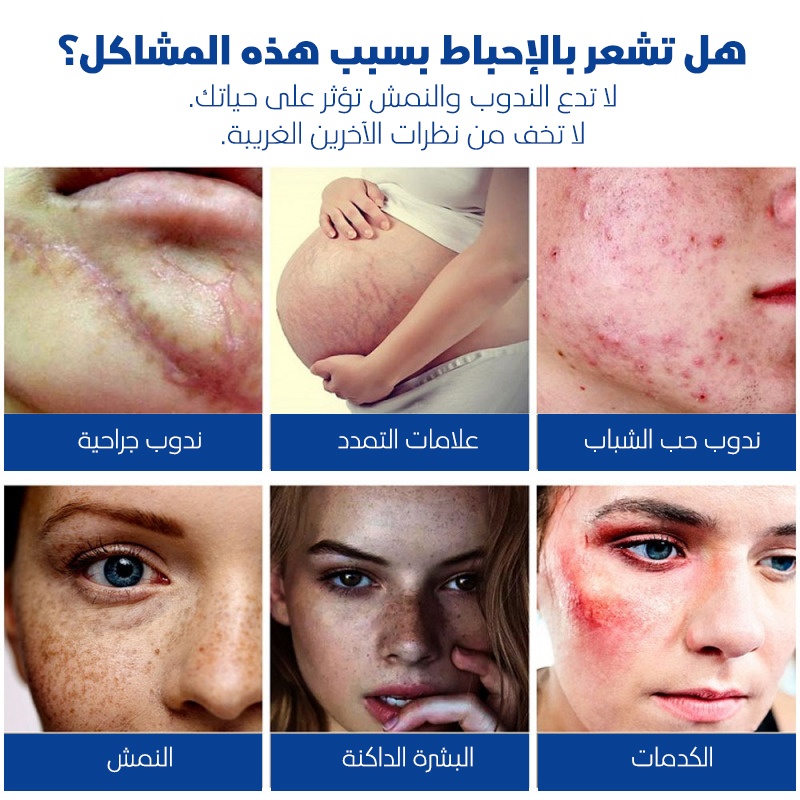 كريم إزالة الندوب والآثار